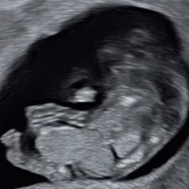 Cover Image for Fetal Imaging Spotter Cases with Dr Gita Krishna Puppala 