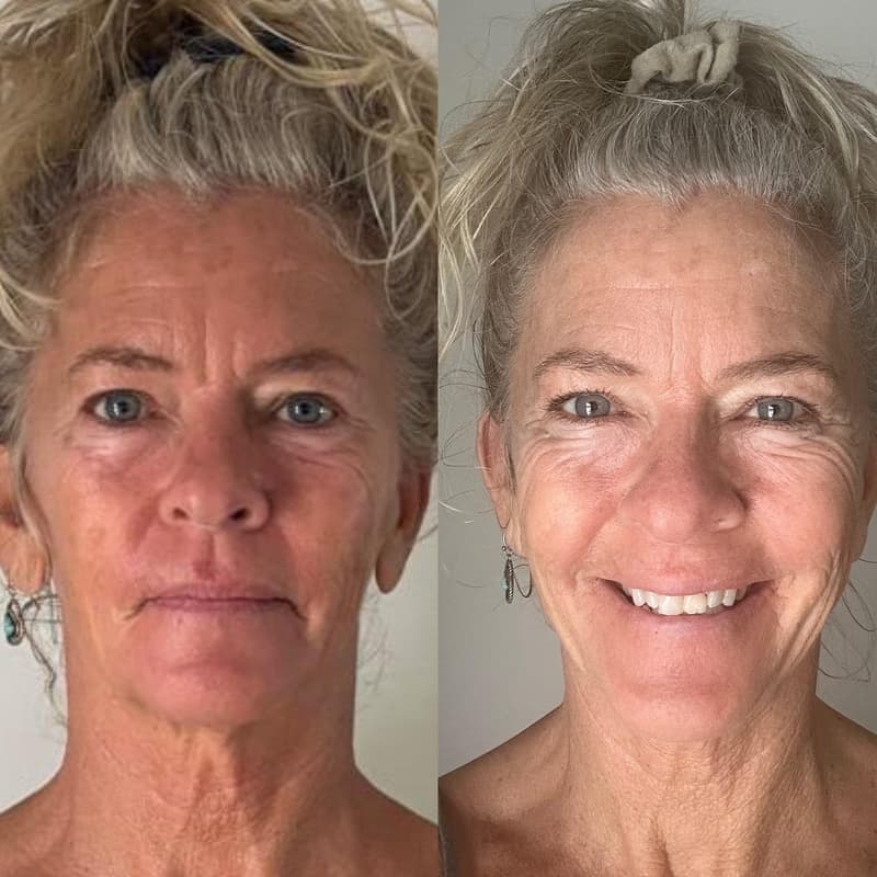 Cover Image for Reverse years of aging in your face — naturally